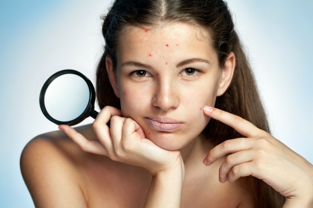 淡化黑色痘印有效的方法 恢复脸蛋光滑 美容健康 第2张
