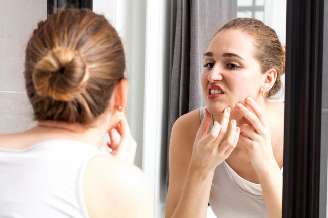 淡化黑色痘印有效的方法 恢复脸蛋光滑 美容健康 第1张